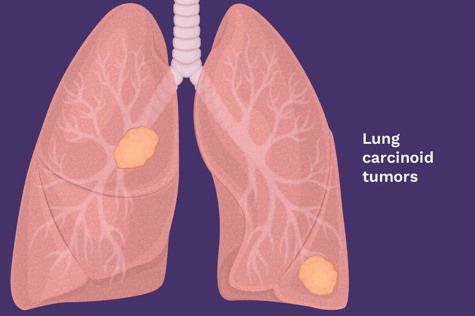 Lung carcinoid tumors